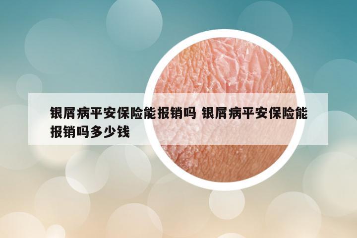 银屑病平安保险能报销吗 银屑病平安保险能报销吗多少钱