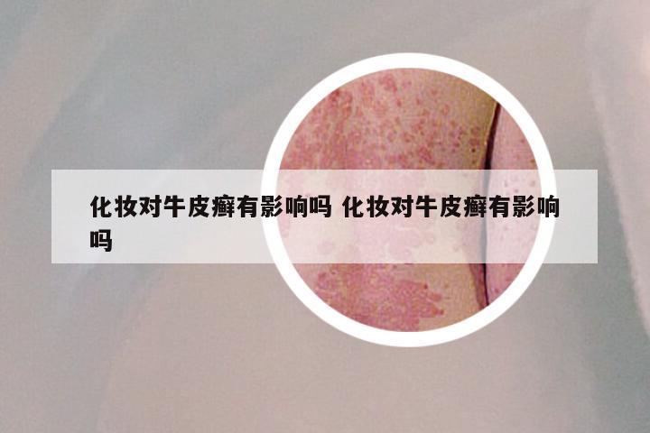 化妆对牛皮癣有影响吗 化妆对牛皮癣有影响吗