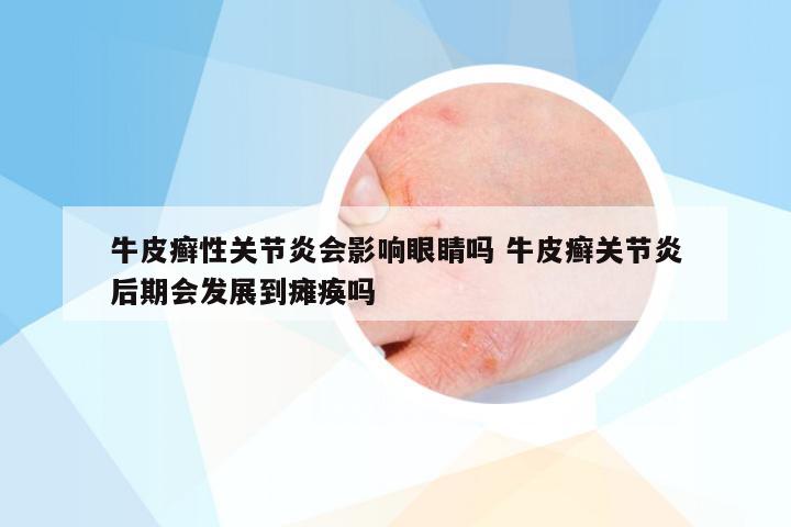 牛皮癣性关节炎会影响眼睛吗 牛皮癣关节炎后期会发展到瘫痪吗