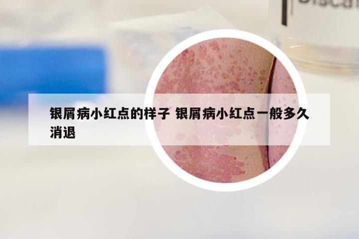 银屑病小红点的样子 银屑病小红点一般多久消退