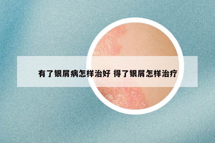 有了银屑病怎样治好 得了银屑怎样治疗