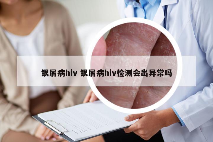 银屑病hiv 银屑病hiv检测会出异常吗